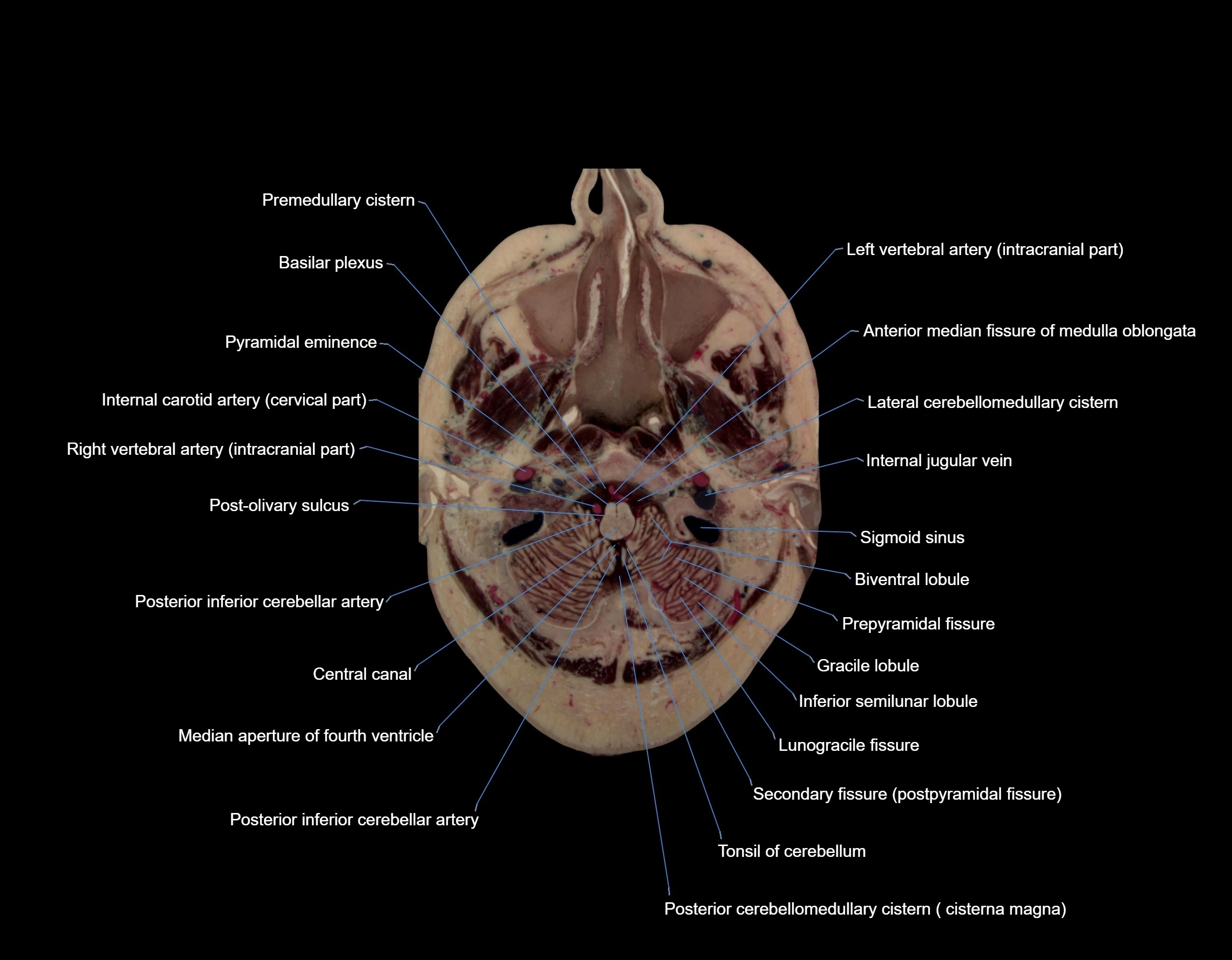 MRI Brain axial cross sectional radiology anatomy 3T image  -img-00005.webp